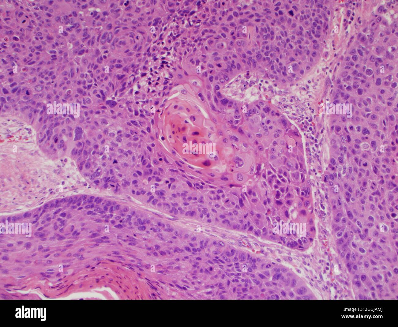 Lung cancer : pulmonary keratinizing squamous cell carcinoma associated with tobbaco use seen under microscope at 400x magnification. Stock Photo