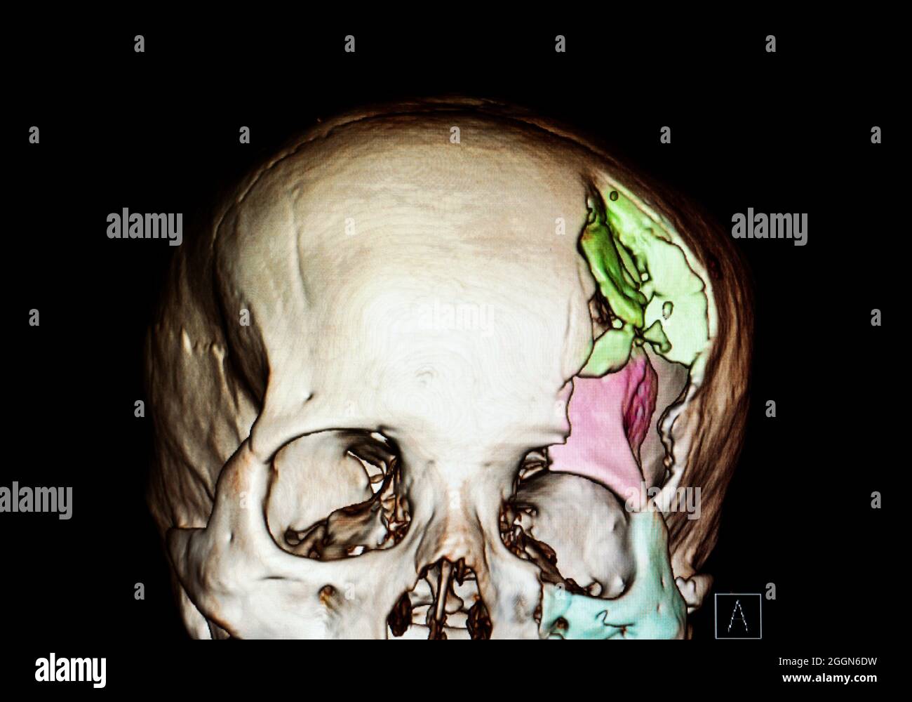 3 D rendering of a skull of a patient with traumatic brain injury showing severe depression fractures of left temporoparietal, supraorbital and zygoma Stock Photo