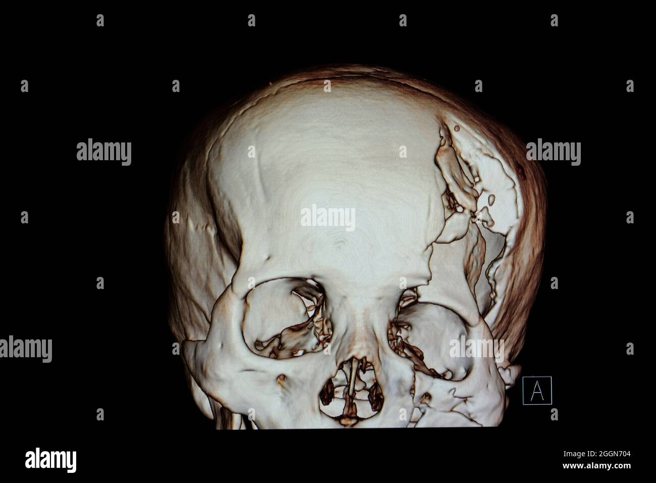 3-D rendering image of a patient skull with traumatic brain injury showing compression fracture of left temperoparietal bone, fracture of left orbital Stock Photo