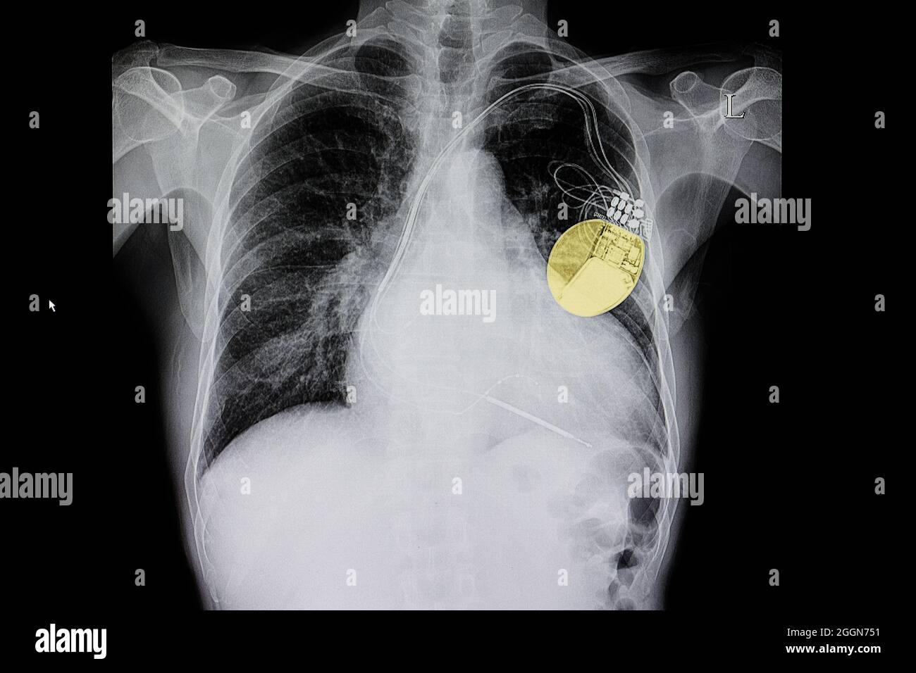 Chest Xray film of a patient with cardiomegaly and a cardiac pacemaker highlighted in yellow in his chest. Stock Photo