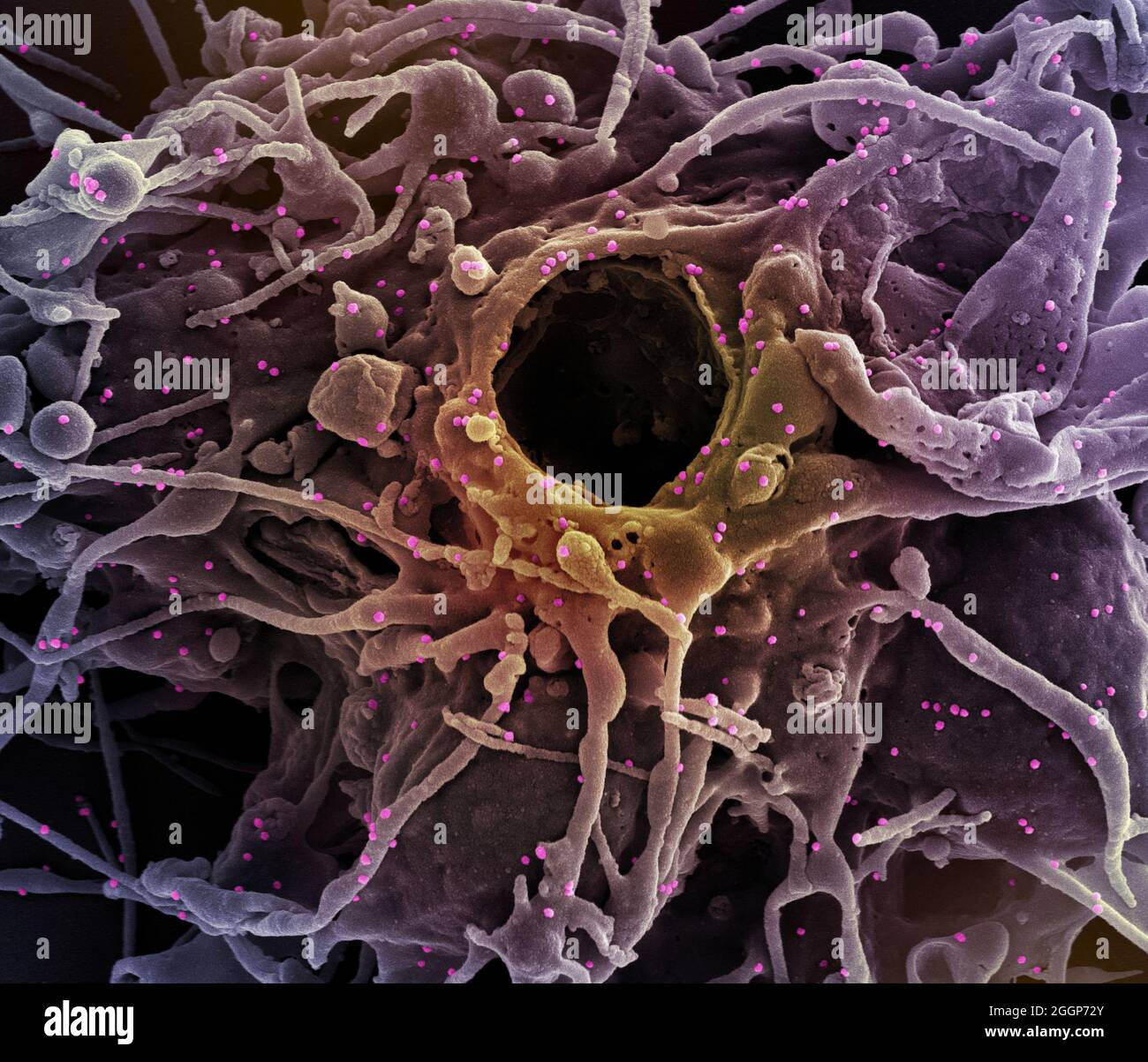 Colorized scanning electron micrograph of a cell (purple) infected with UK B. Stock Photo
