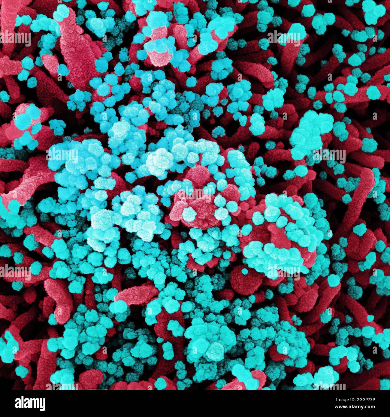 Scanning electron micrograph of a cell heavily infected with SARS-CoV-2 virus particles (blue), isolated from a patient sample. Stock Photo