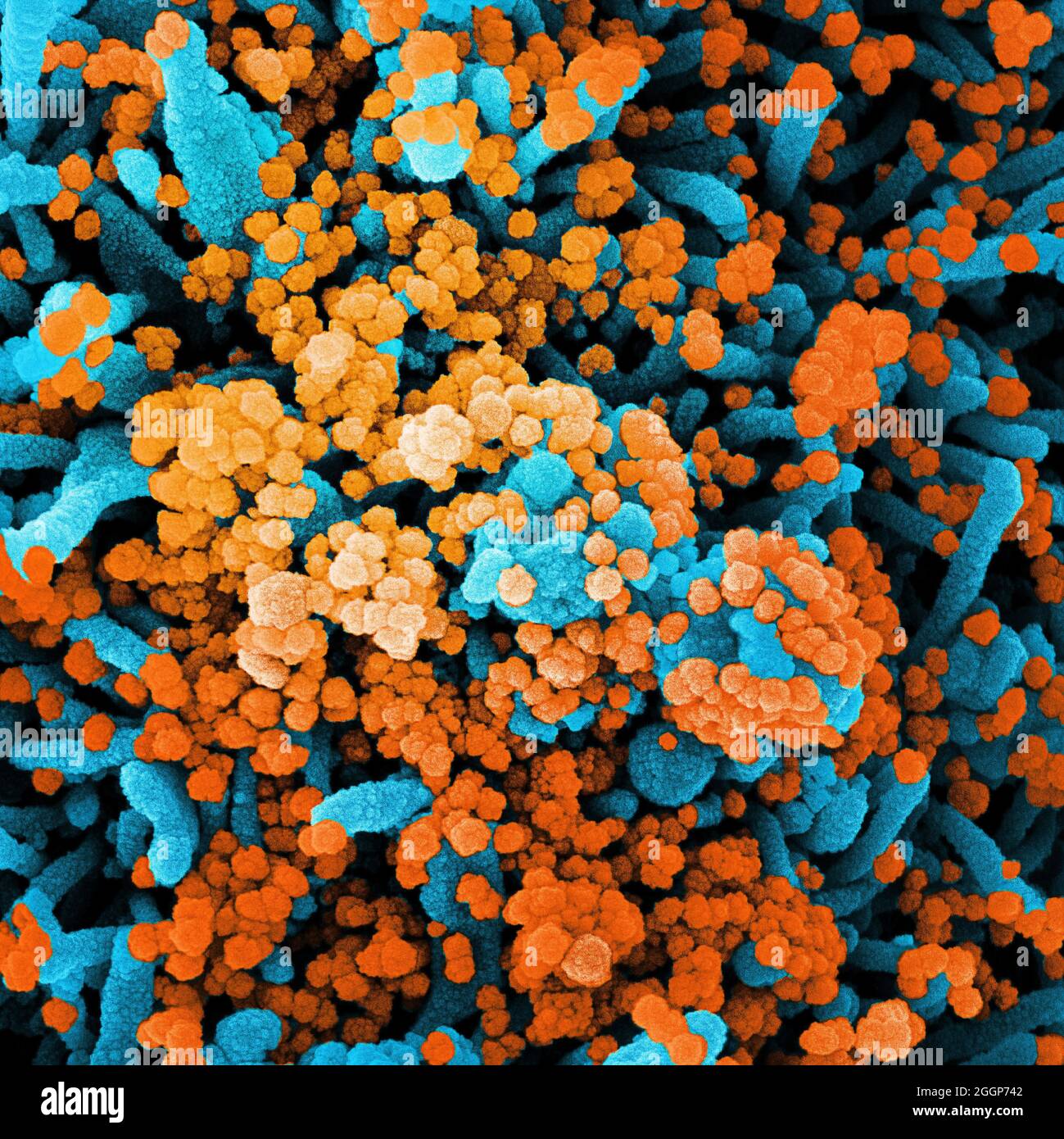 Scanning electron micrograph of a cell heavily infected with SARS-CoV-2 virus particles (orange), isolated from a patient sample. Stock Photo