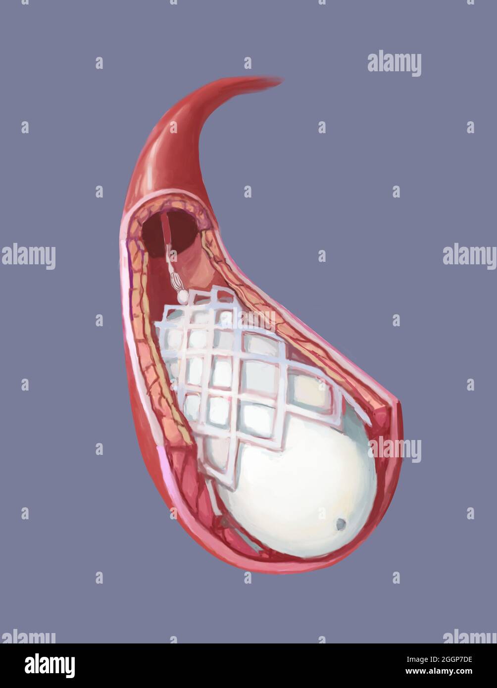 Medical illustration showing balloon angioplasty and stent insertion. Stock Photo