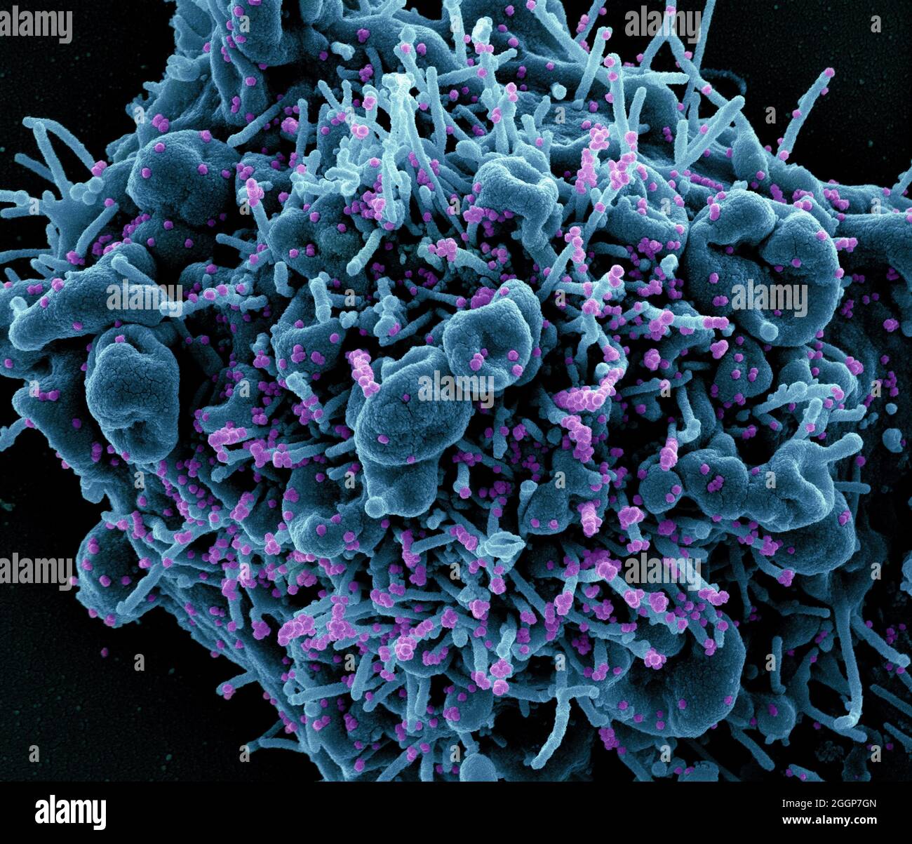 Colorized scanning electron micrograph of an apoptotic cell (teal) infected with SARS-COV-2 virus particles (purple), isolated from a patient sample. Stock Photo