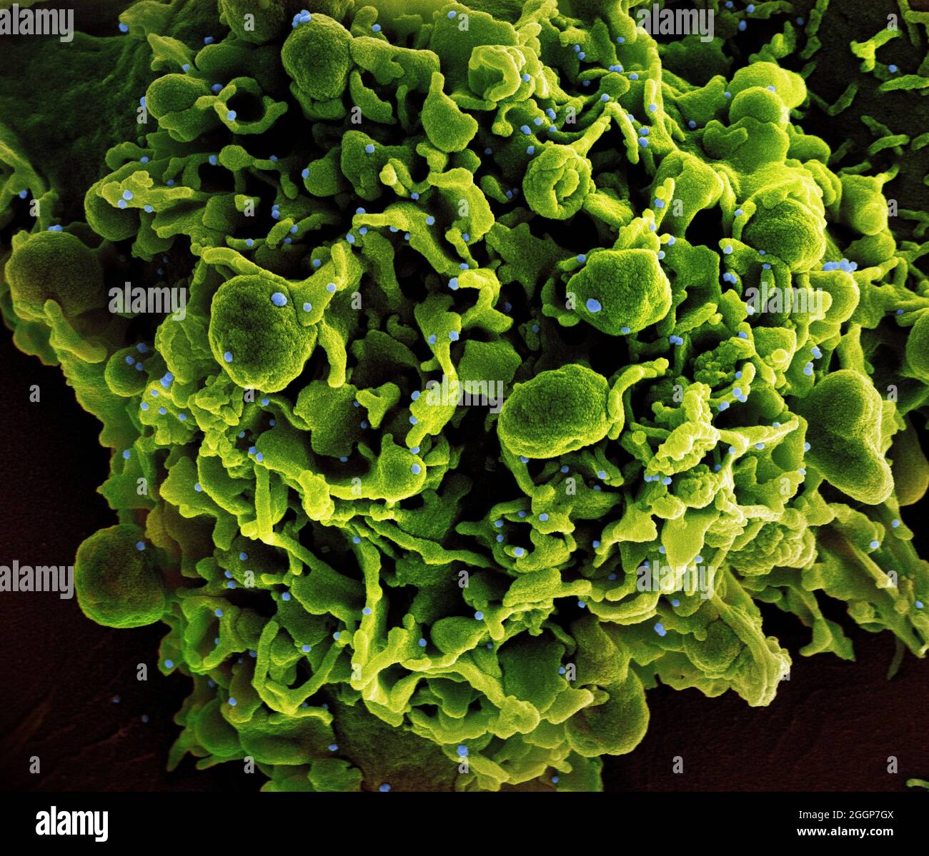 Colorized scanning electron micrograph of a cell (green) infected with SARS-CoV-2 virus particles (blue, isolated from a patient sample. Stock Photo