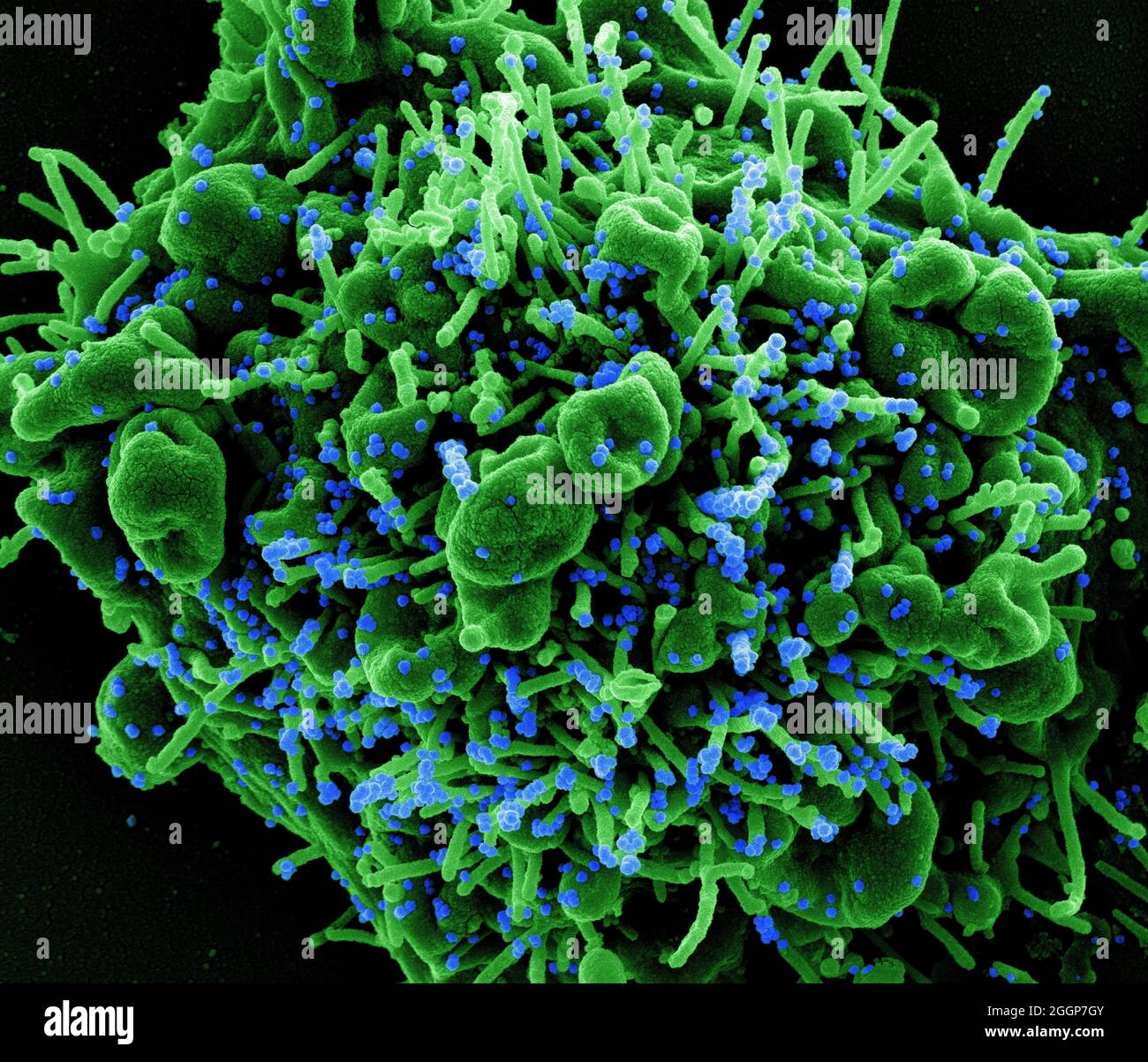 Colorized scanning electron micrograph of an apoptotic cell (green) infected with SARS-COV-2 virus particles (blue), isolated from a patient sample. Stock Photo
