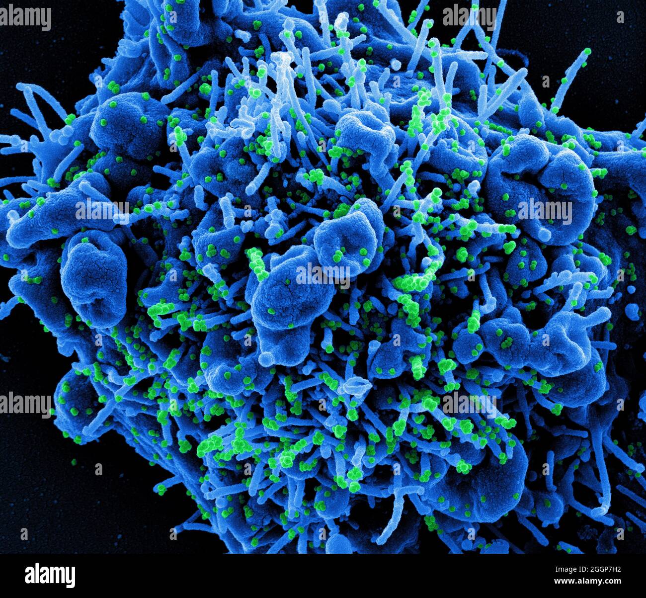 Colorized scanning electron micrograph of an apoptotic cell (blue) infected with SARS-COV-2 virus particles (green), isolated from a patient sample. Stock Photo
