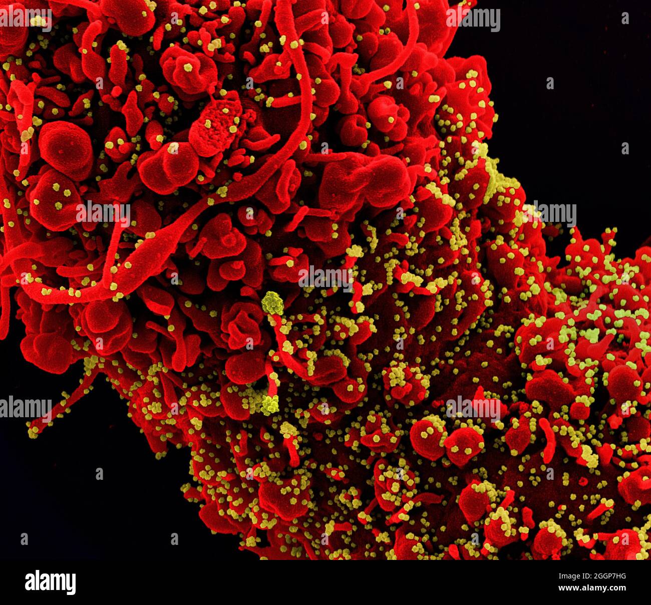 Colorized scanning electron micrograph of a cell (red) showing morphological signs of apoptosis, infected with SARS-COV-2 virus particles (yellow), isolated from a patient sample. Stock Photo