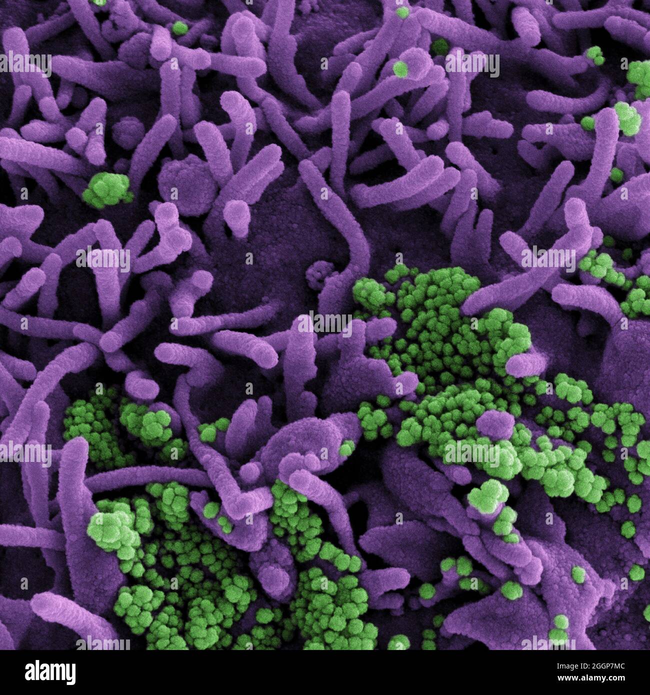 Colorized scanning electron micrograph of a cell (purple) infected with SARS-CoV-2 virus particles (green), isolated from a patient sample. Stock Photo