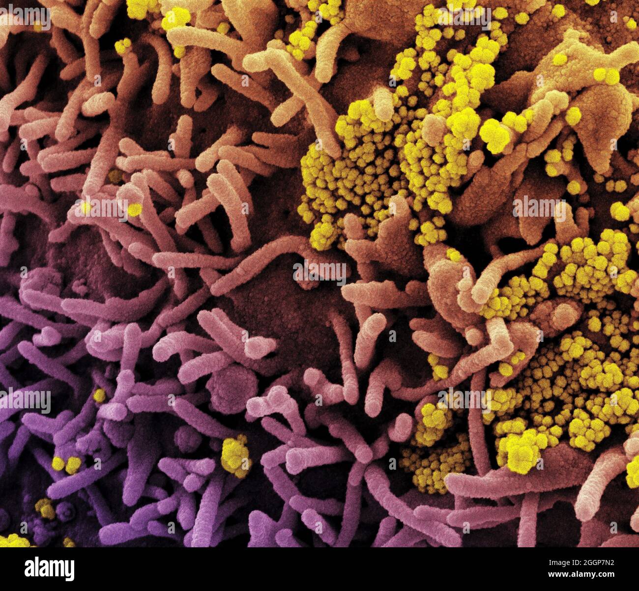 Colorized scanning electron micrograph of a cell (tan) infected with SARS-CoV-2 virus particles (yellow), isolated from a patient sample. Stock Photo