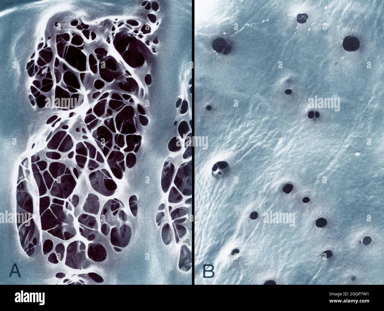 Colorized transmission electron micrographs showing, A: internal elastic lamina of an aorta, characterized by large fenestrations traversed by an irregular meshwork of elastic strands, and, B: a similar view of the internal elastic lamina of the femoral artery shows small fenestrations. Stock Photo