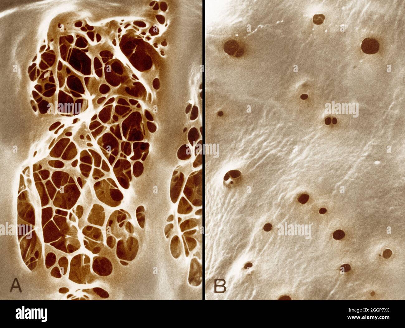 Colorized transmission electron micrographs showing, A: internal elastic lamina of an aorta, characterized by large fenestrations traversed by an irregular meshwork of elastic strands, and, B: a similar view of the internal elastic lamina of the femoral artery shows small fenestrations. Stock Photo