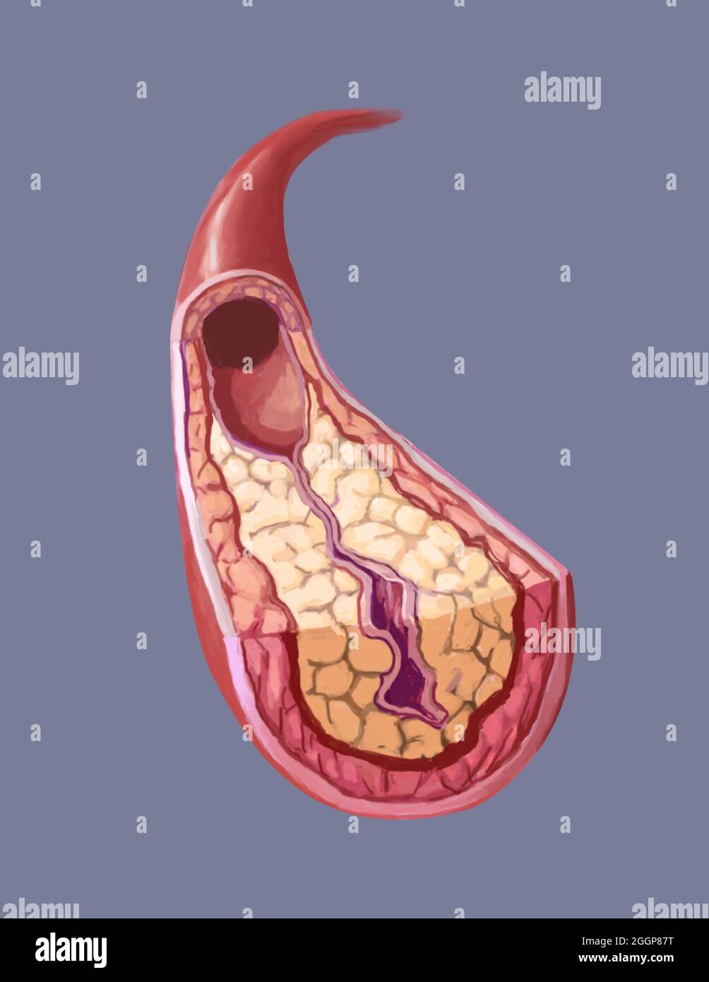 A clogged artery or Atherosclerosis (arteriosclerotic vascular disease