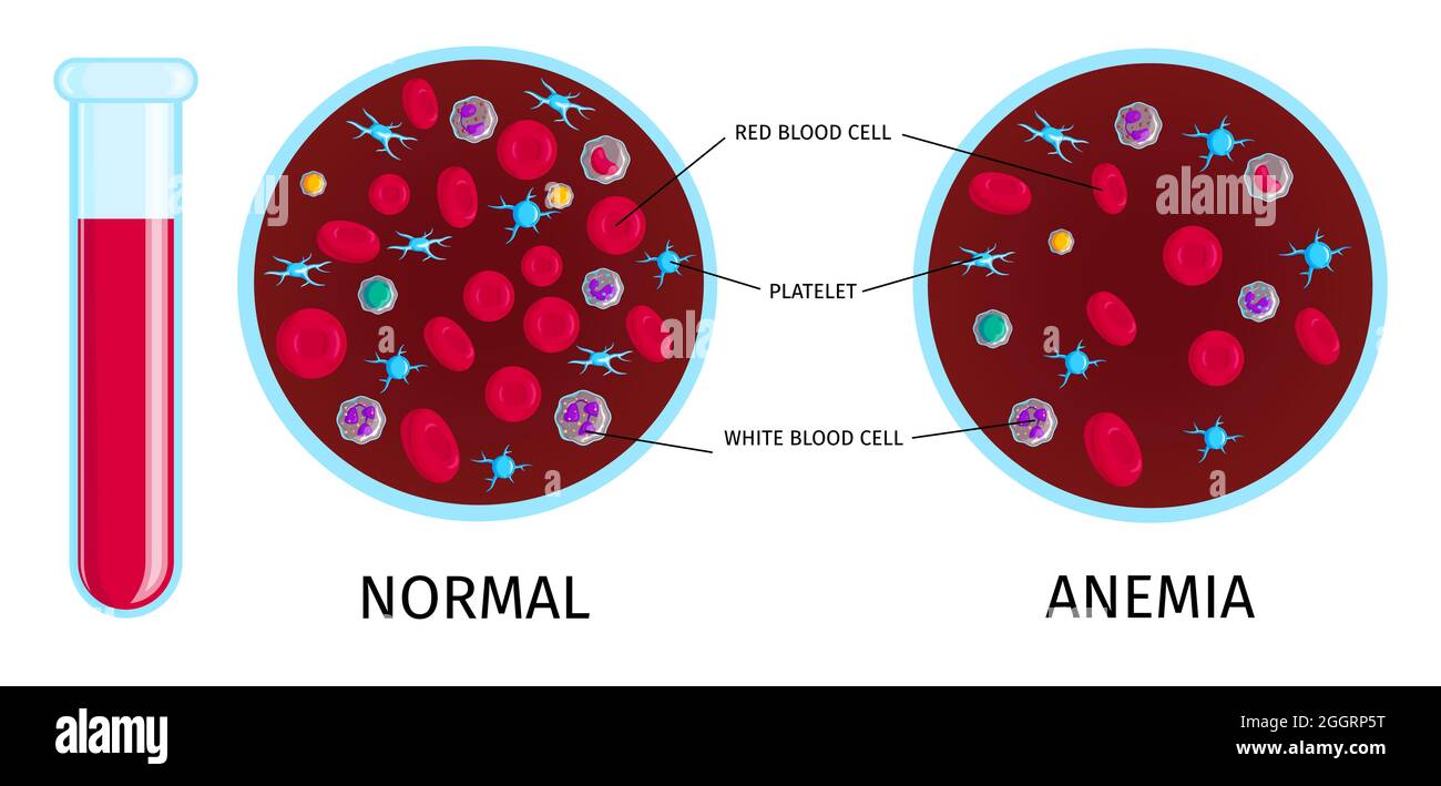 Anemia colorful educative info chart with test tube normal and low