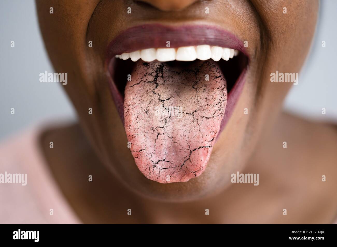 Woman Tongue With Bad Bacteria Candidiasis And Pain Stock Photo