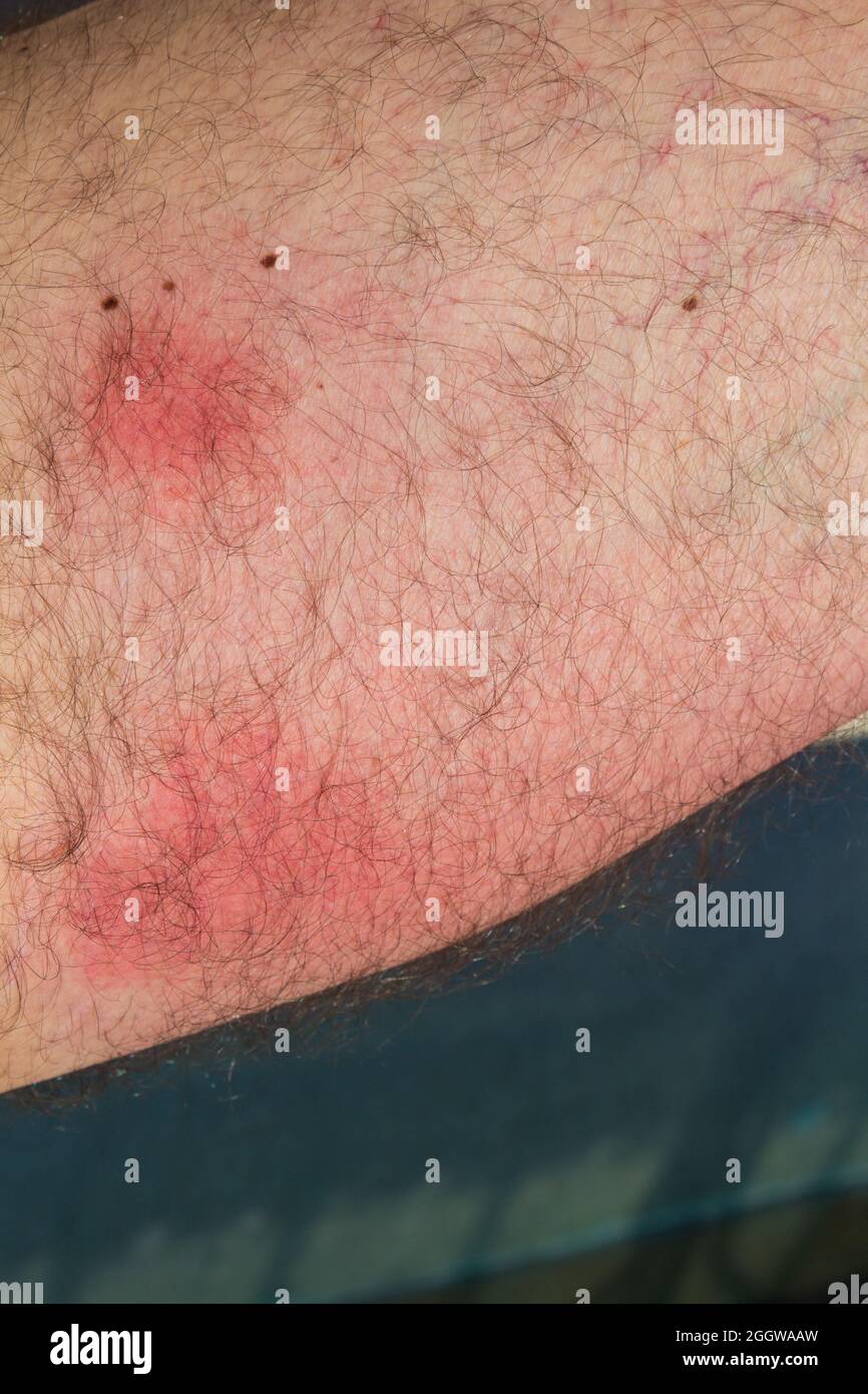 Wasp stings on skin after two day, red inflammation marks caused by wasp bite Stock Photo