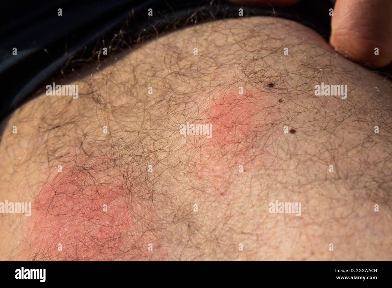 Wasp stings on skin after one day, red inflammation marks caused by wasp bite Stock Photo