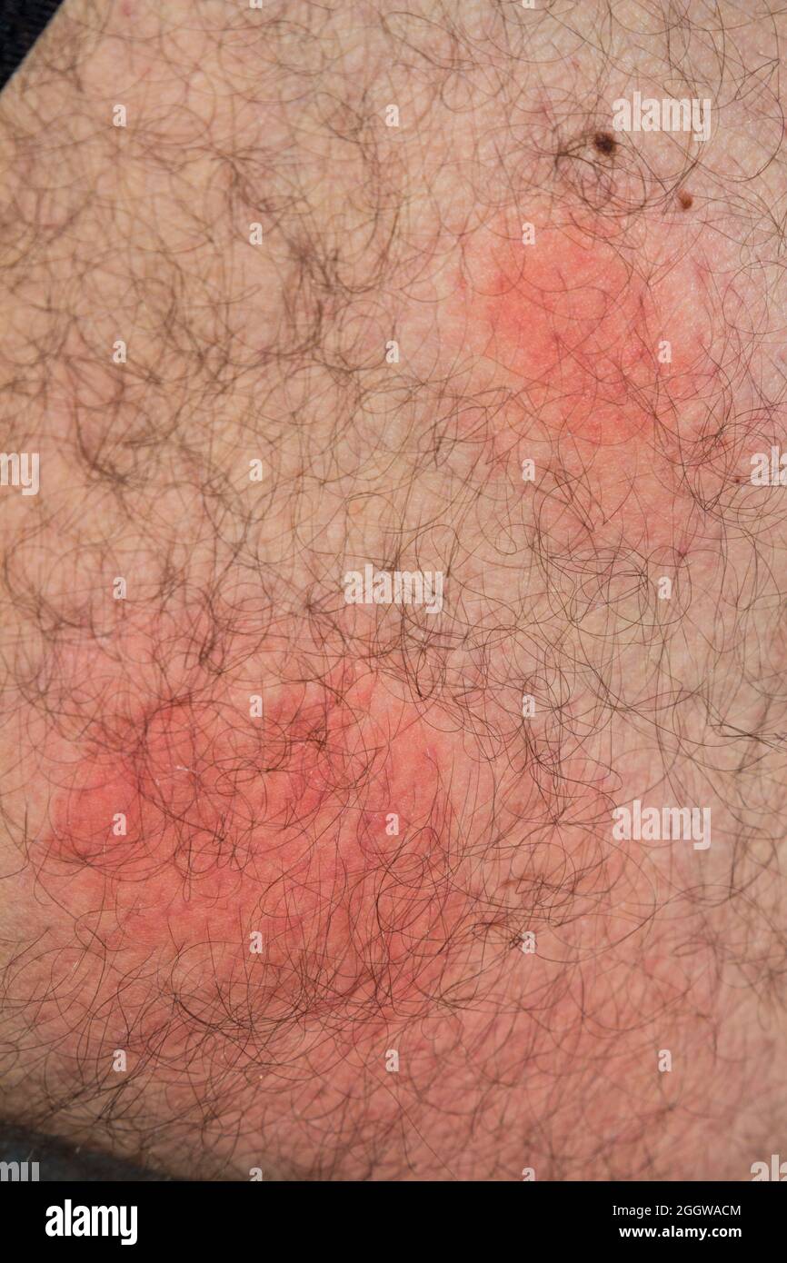 Wasp stings on skin after one day, red inflammation marks caused by wasp bite Stock Photo