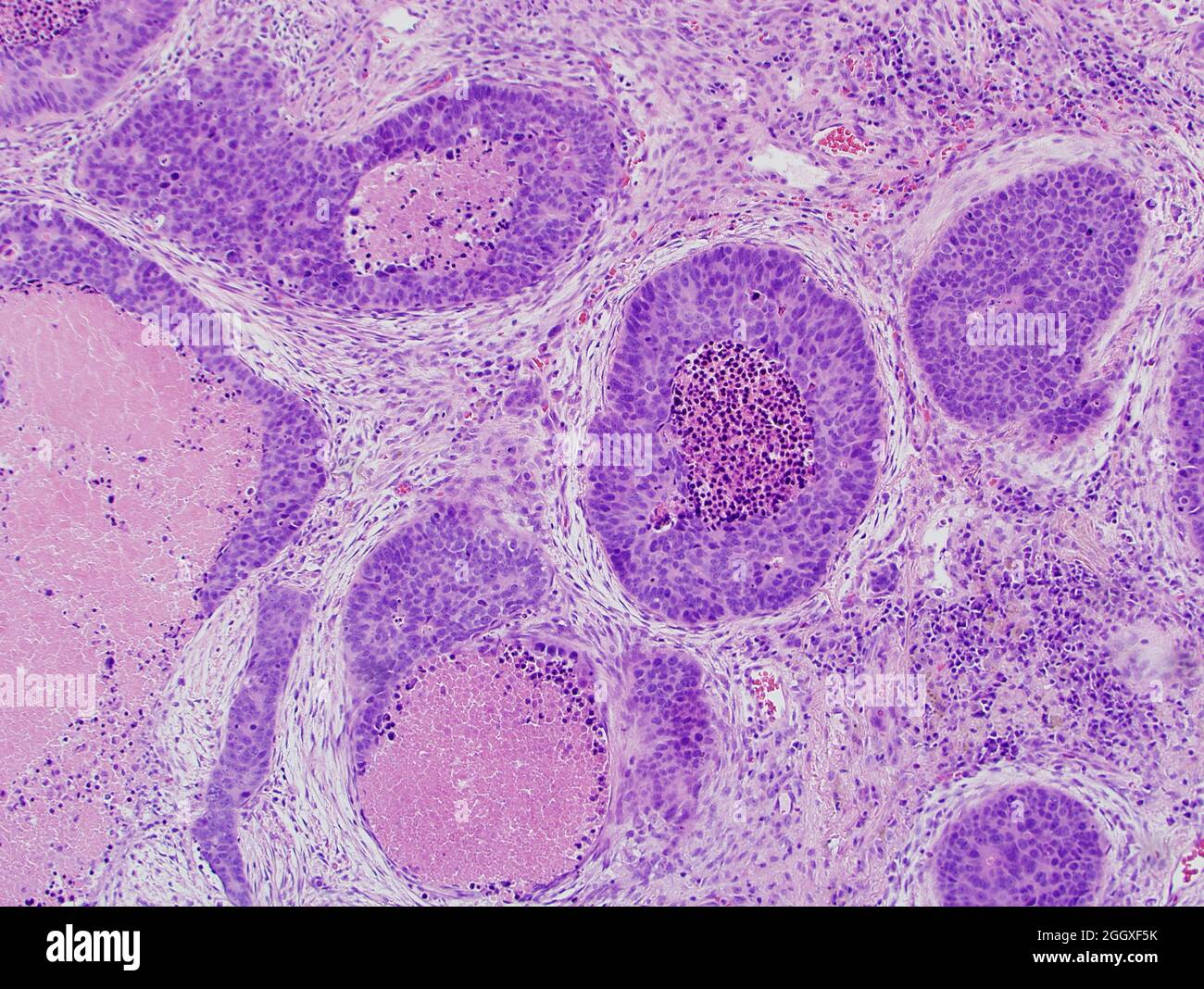 Lung cancer large cell neuroendocrine carcinoma Stock Photo Alamy