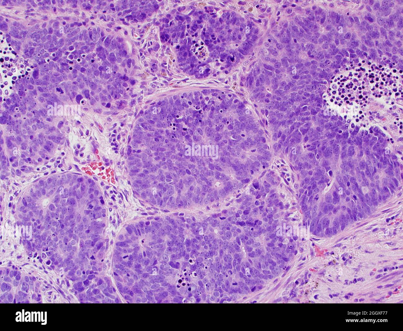 Lung cancer: large cell neuroendocrine carcinoma Stock Photo