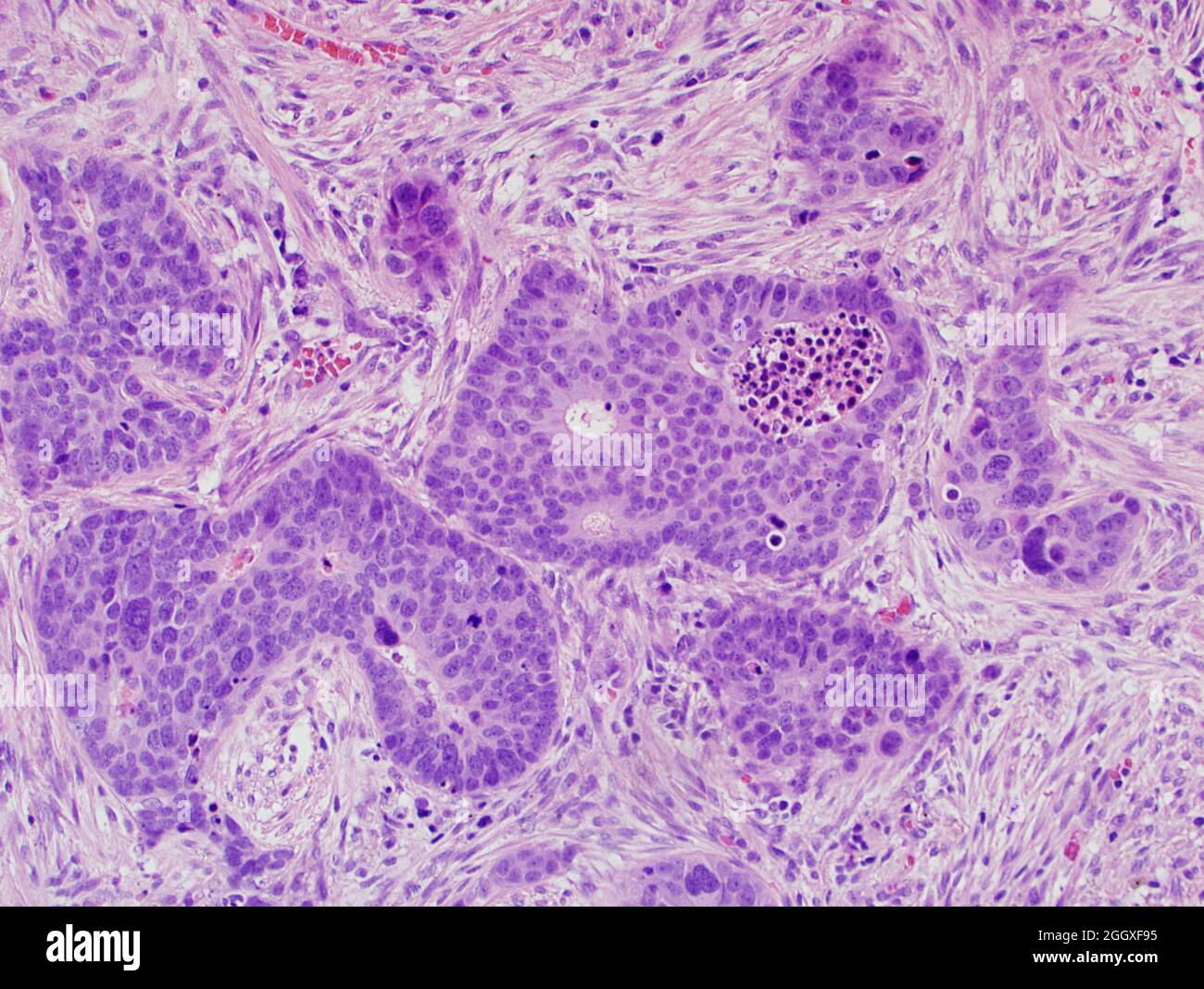 Lung cancer large cell neuroendocrine carcinoma Stock Photo Alamy