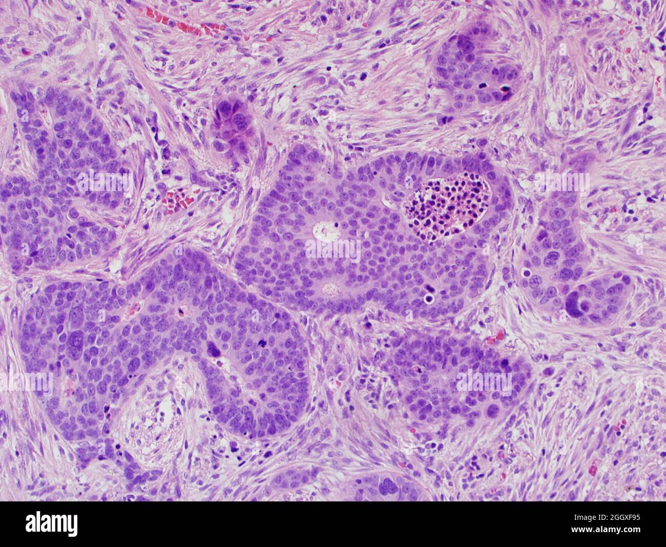 Lung cancer: large cell neuroendocrine carcinoma Stock Photo