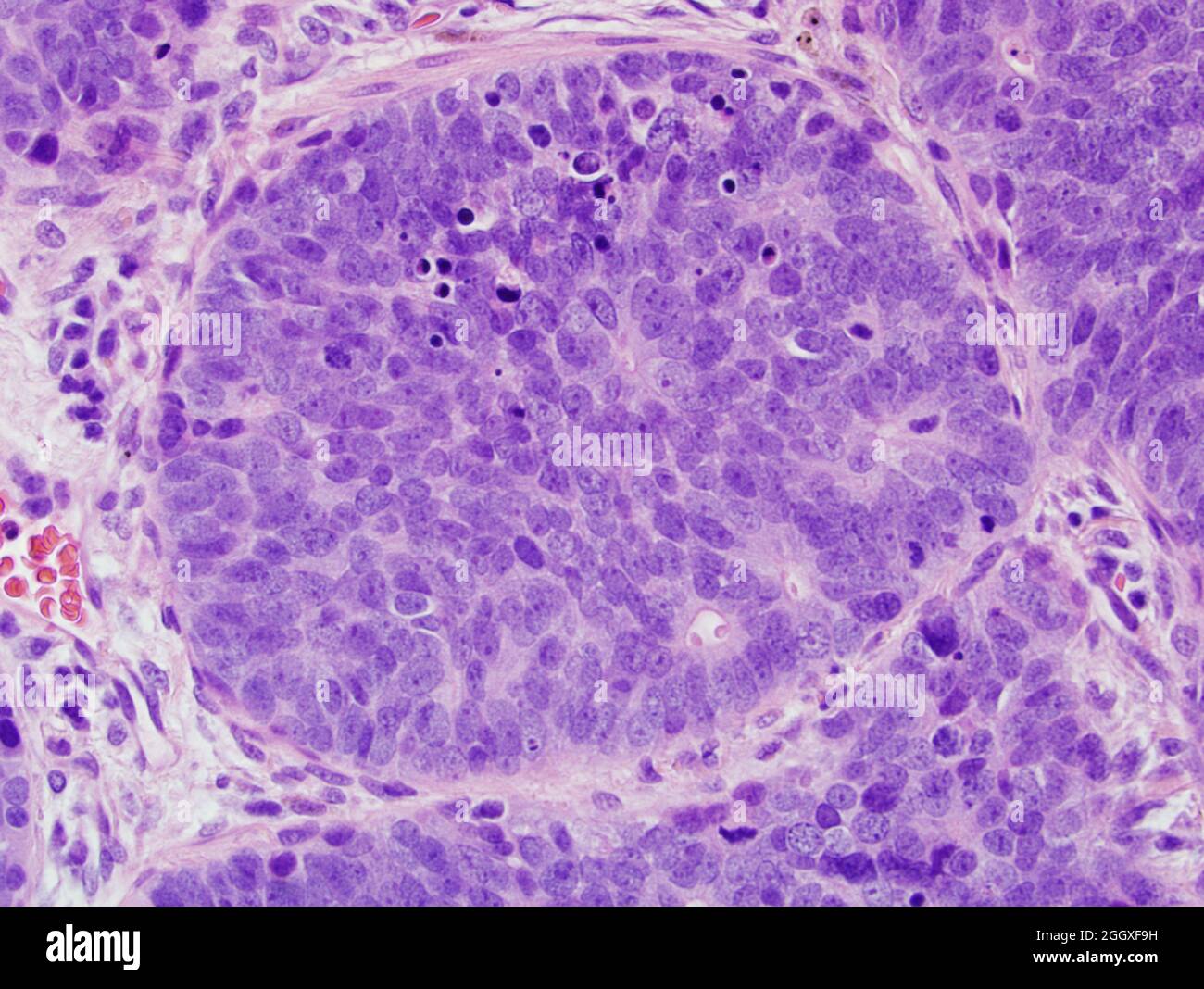 Lung cancer: large cell neuroendocrine carcinoma Stock Photo