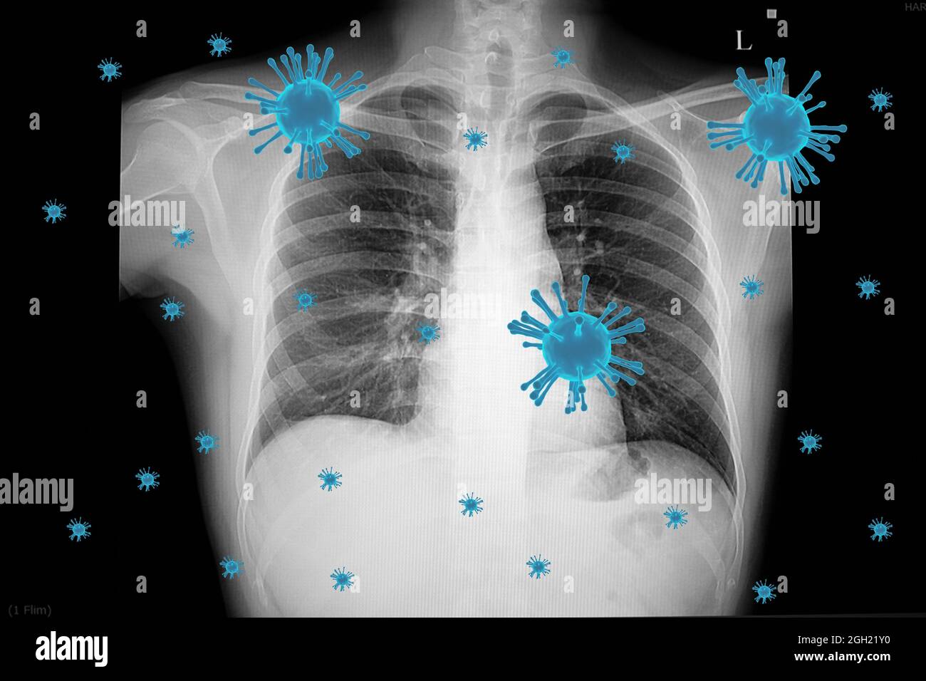 Visual illustration of coronavirus (covid-19) infection in the lungs with 3D rendered viral particles and a chest xray film of a patient with right lo Stock Photo