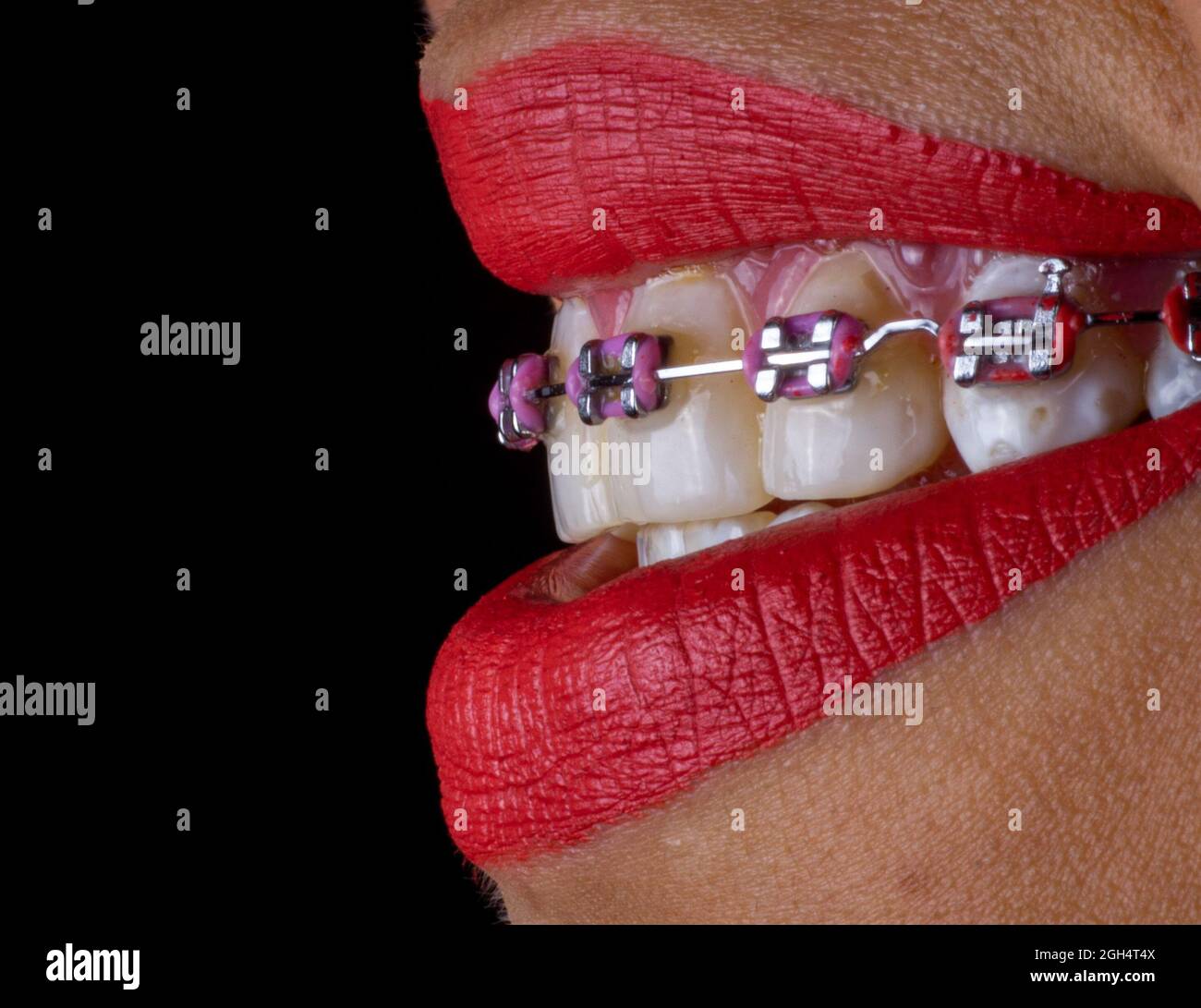Braces And Lipstick Tumblr