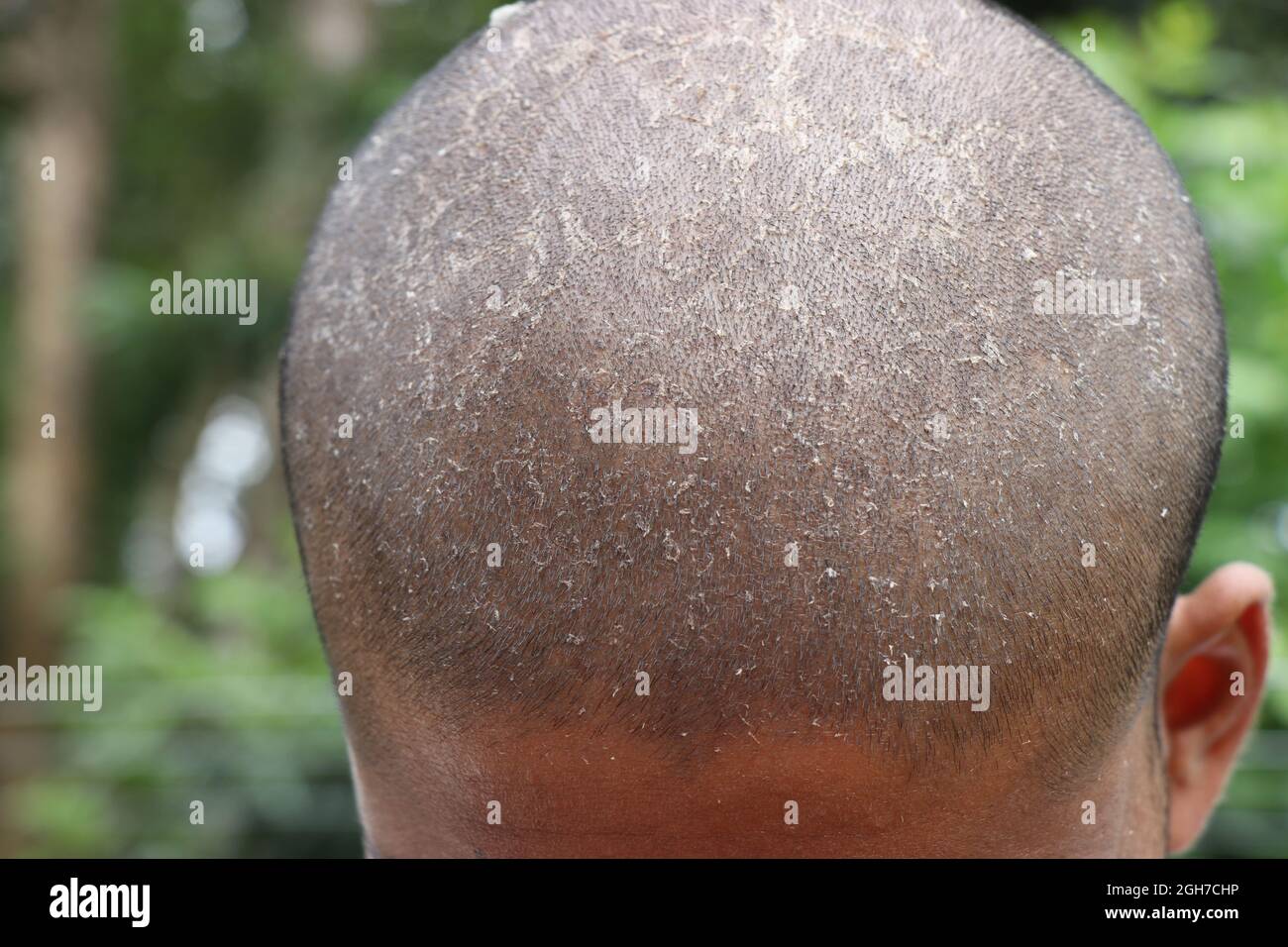 very short hairs in a male head with scales on the scalp, White dried skin all overhead, dryness of scalp, unhealthy head skin Stock Photo