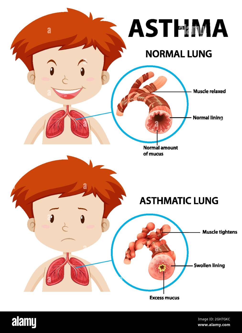 Asthma diagram with normal lung and asthmatic lung illustration Stock