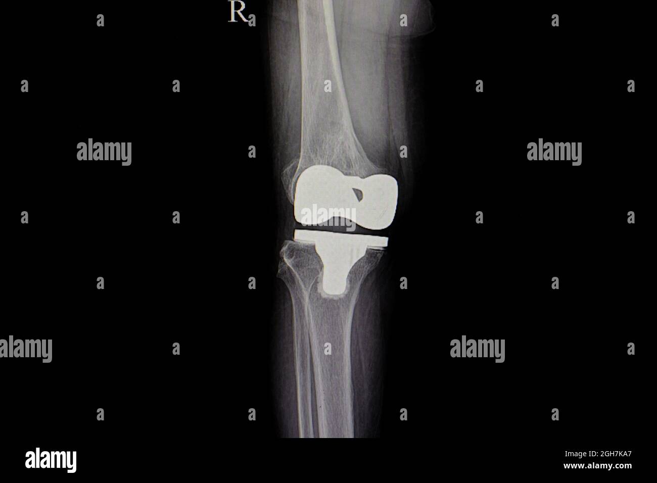 Xray film of human total knee replacement with titanium joint Stock Photo Alamy