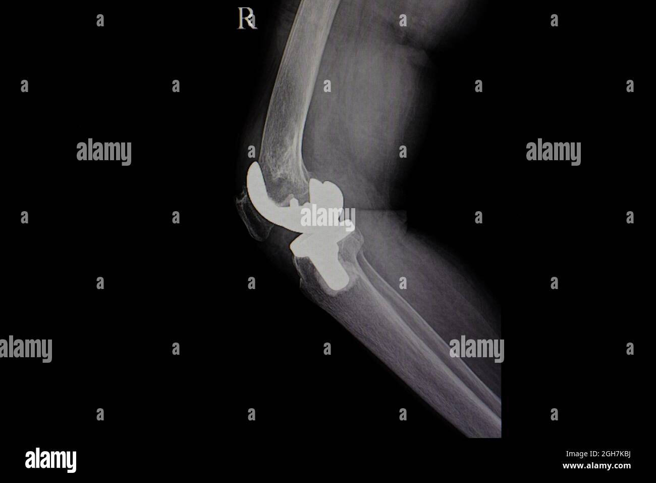 Xray film of human knee with titanium knee prosthesis Stock Photo
