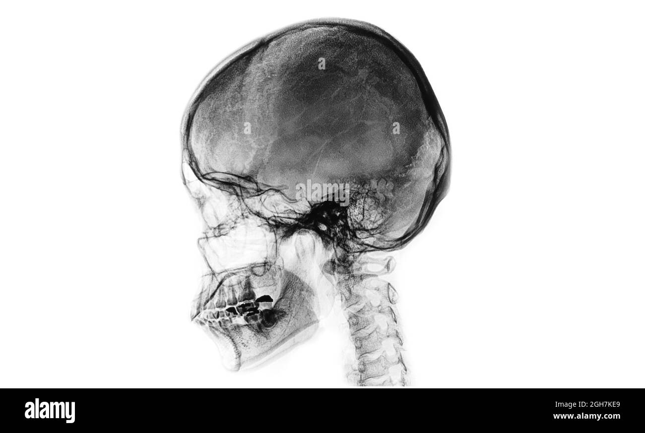 A reversed contrast  skull film of a patient in black and white. Stock Photo