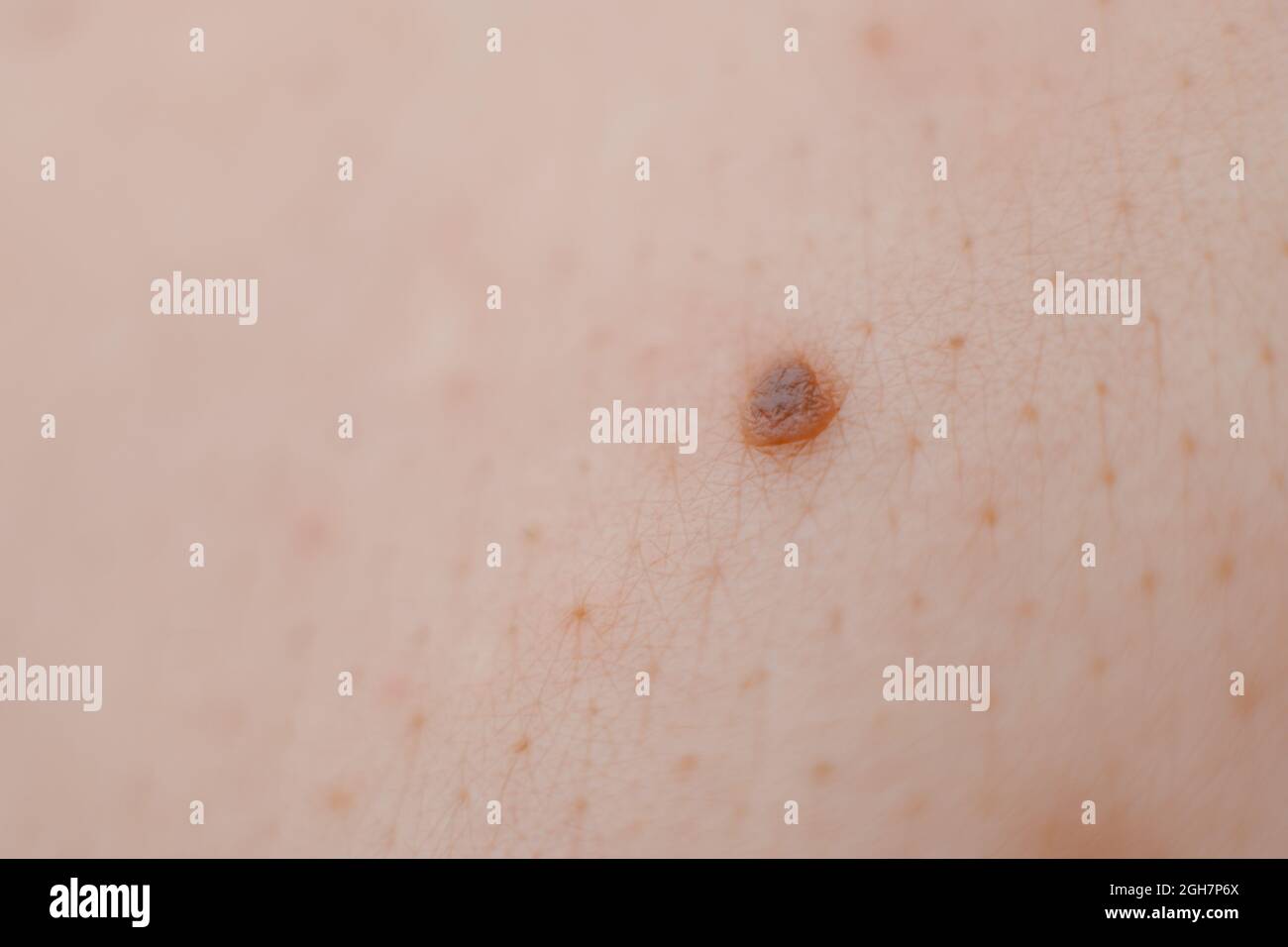 Close up of mole and human skin texture Stock Photo Alamy