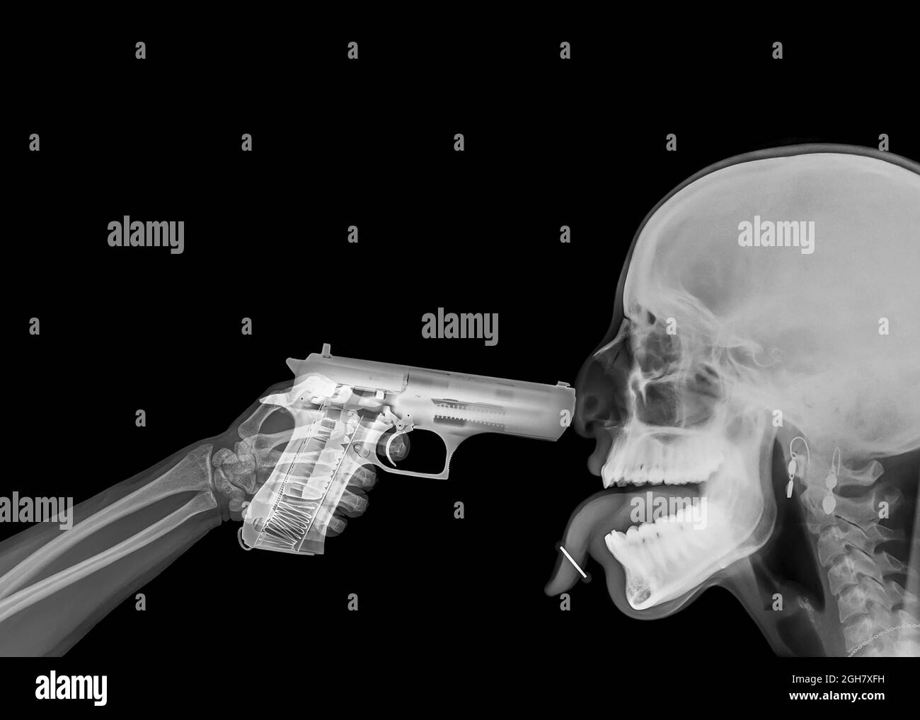 x ray of a hand pointing a handgun at someones head Stock Photo