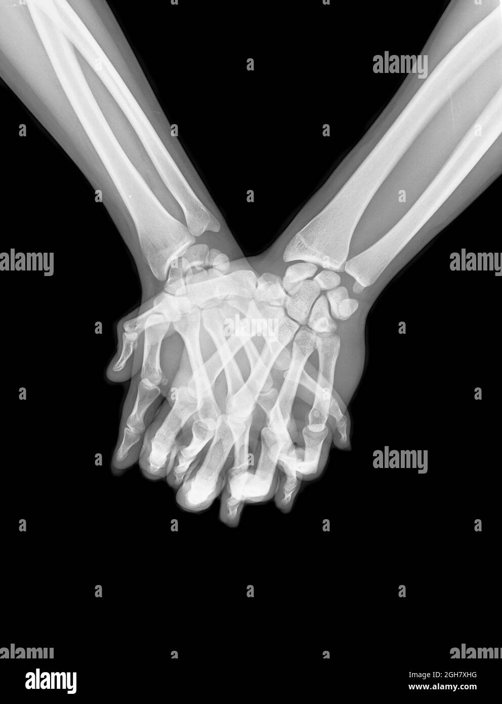 x-ray of a couple Holding Hands Stock Photo