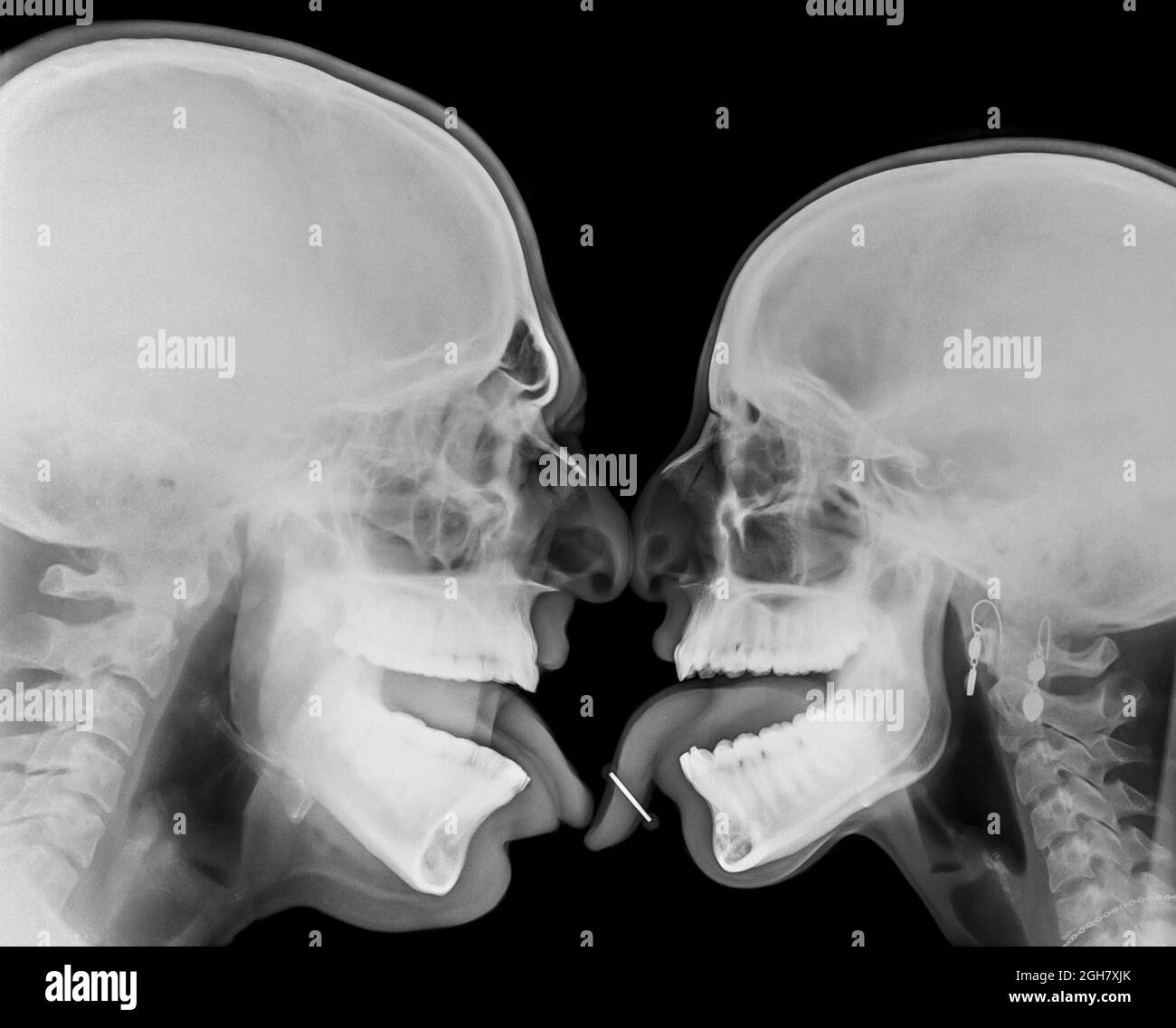 Kissing Couple. Two people kissing under x-ray pierced tongue can be seen Stock Photo