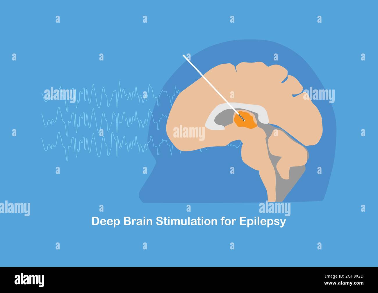 Deep brain stimulation or DBS at anterior thalamic nucleus for treatment of drug resistant epilepsy. Stock Vector