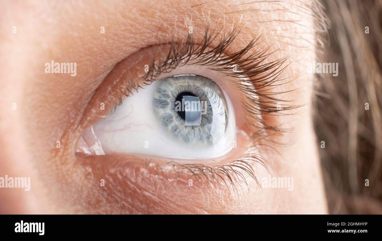 woman eye with corneal dystrophy, keratoconus, thinning of the cornea. Stock Photo