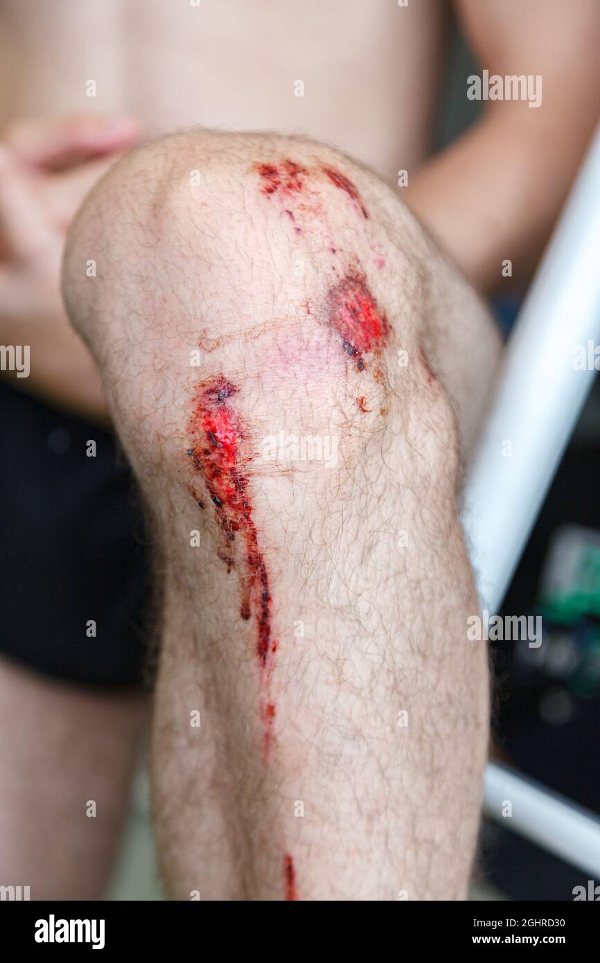 Bruise knee hi-res stock photography and images - Alamy
