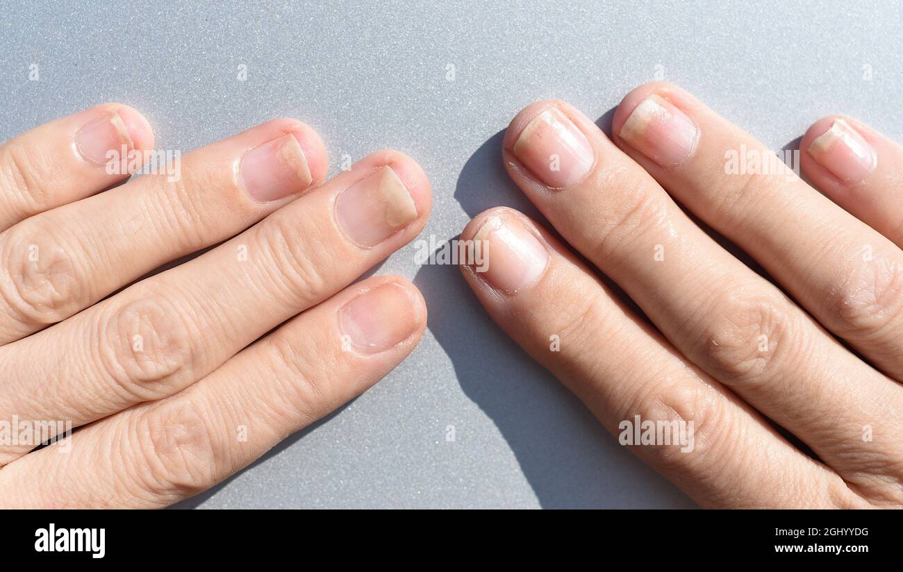 Fungal nail infection, onycholysis after shellac or gel-varnish Stock Photo - Alamy Fungal nail infection, onycholysis after shellac or gel-varnish Stock Photo - Alamy