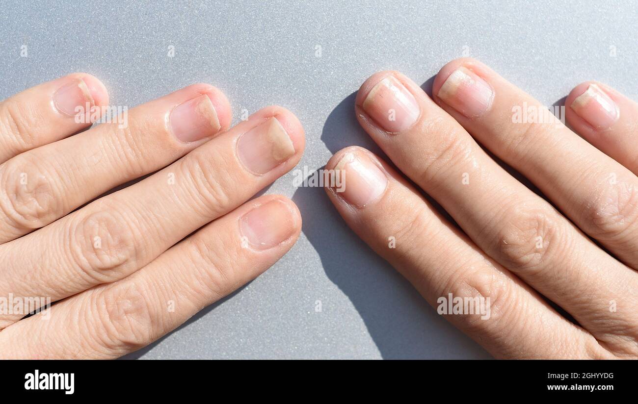 Fungal nail infection, onycholysis after shellac or gel-varnish Stock Photo