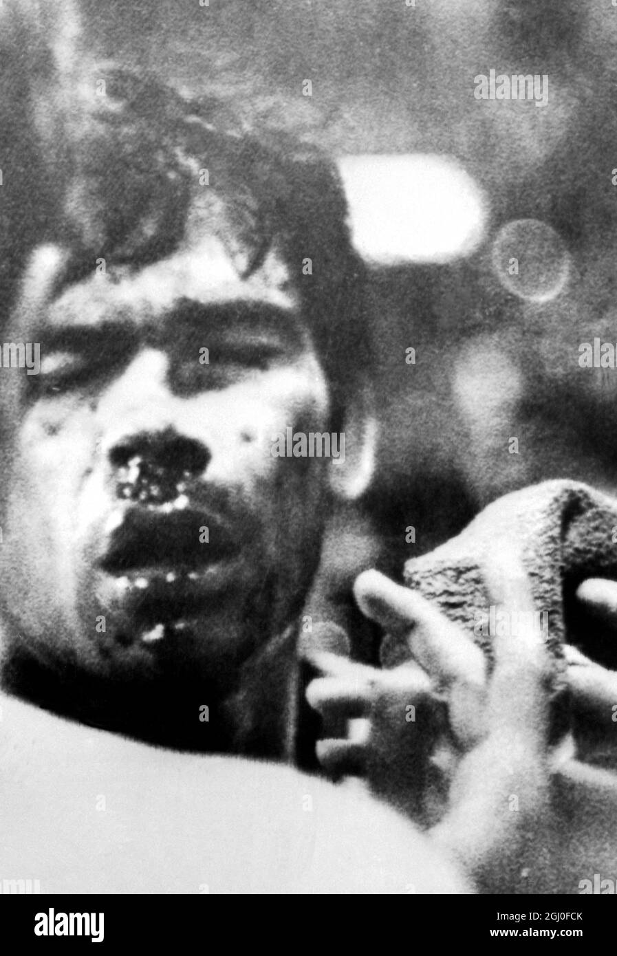The blood spattered face of AC Milan's Argentine born player Nestor Combin who was carried off during Wednesday evenings World Club Championship match against Estudiantes of Argentina. Three Estudiantes players have benn arrested on charges arising from the brawl. Combin was one of two Milan players carried from the field as Milan lost the leg 2-1, but won 4-2 on aggregate. 24th October 1969. Stock Photo