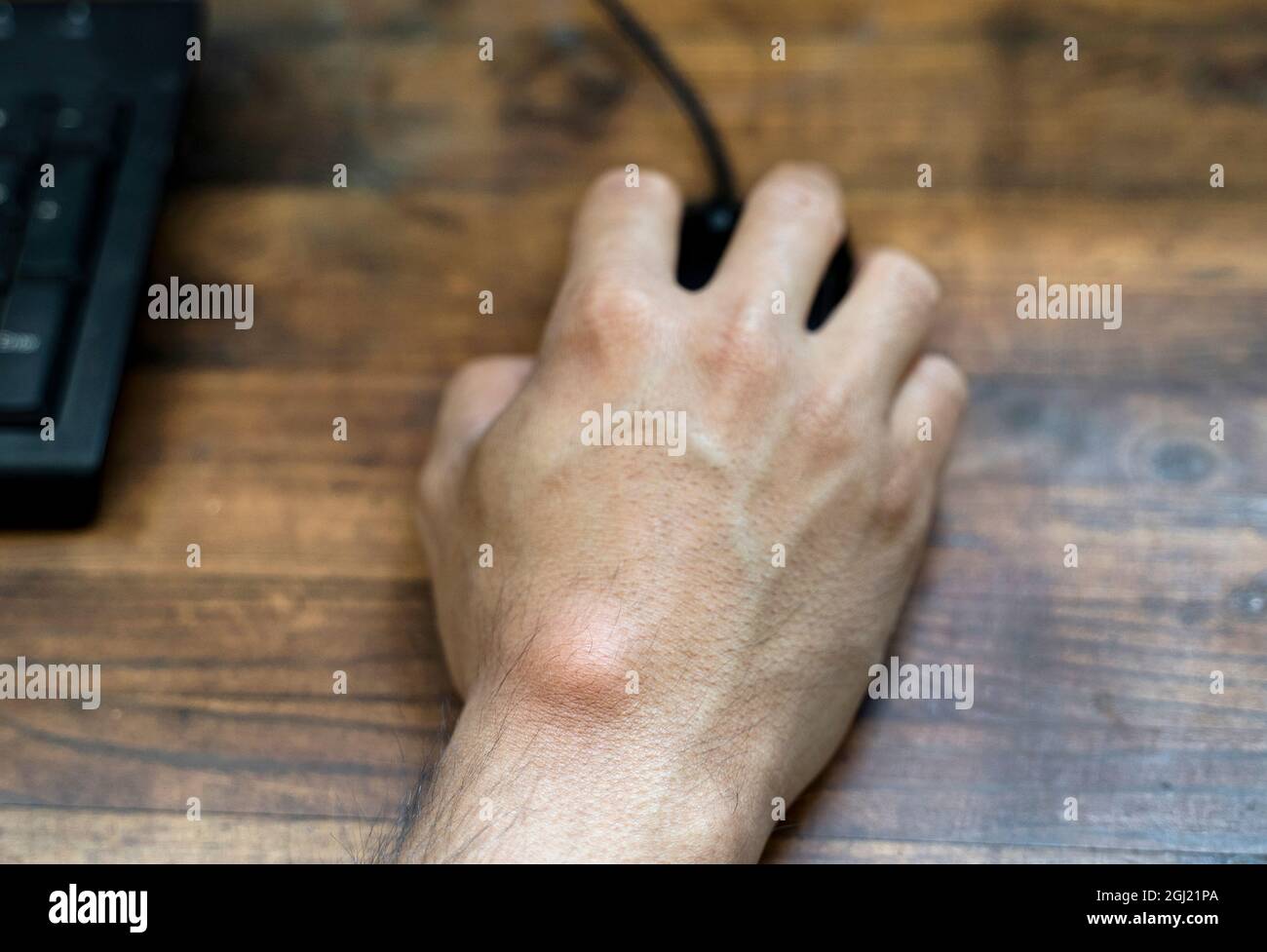 Computer Mouse Cyst Ganglion cyst hi-res stock photography and images - Alamy