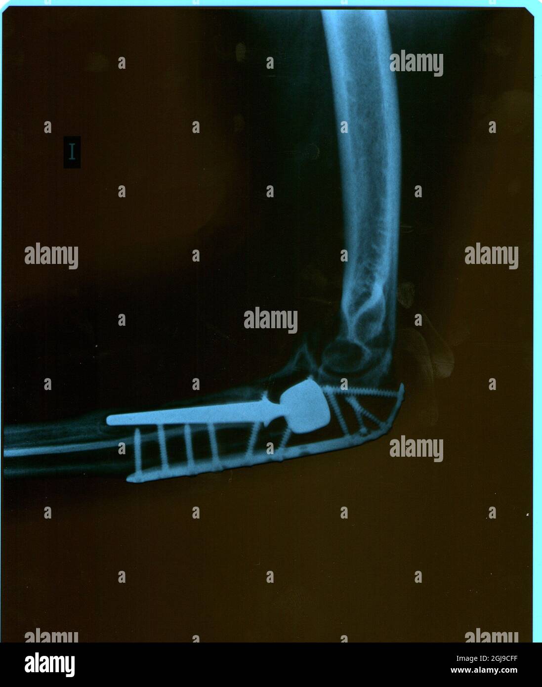 Xray of an elbow showing the plate and screws with prosthesis Stock