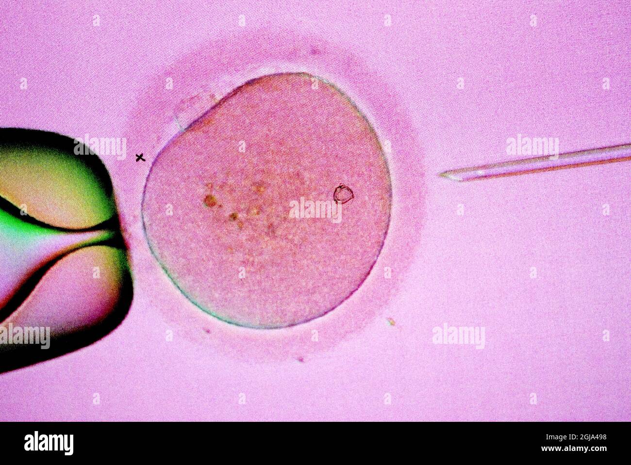 STOCKHOLM 20070323 Intracytoplasmic injection of sperms into a female egg, In vitro