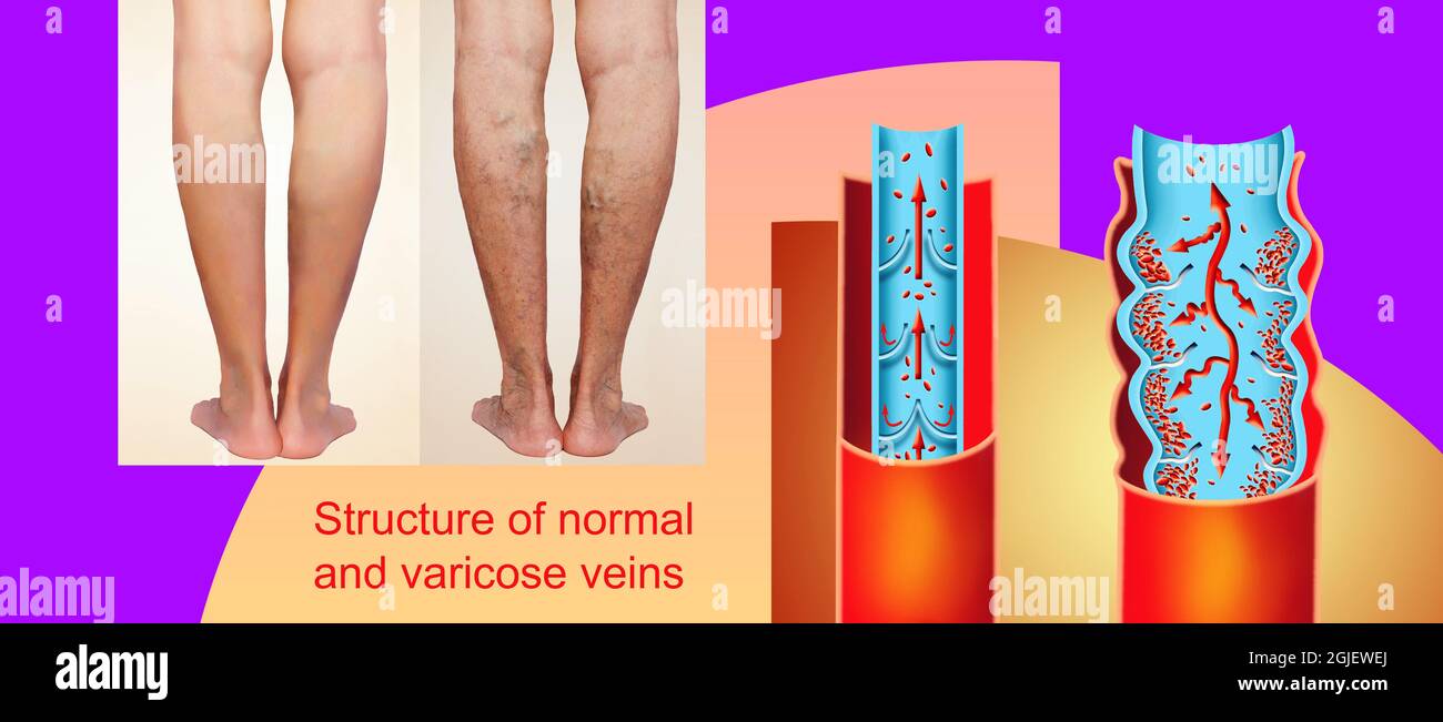The old age and sick of a woman. Varicose veins on a legs of woman. The