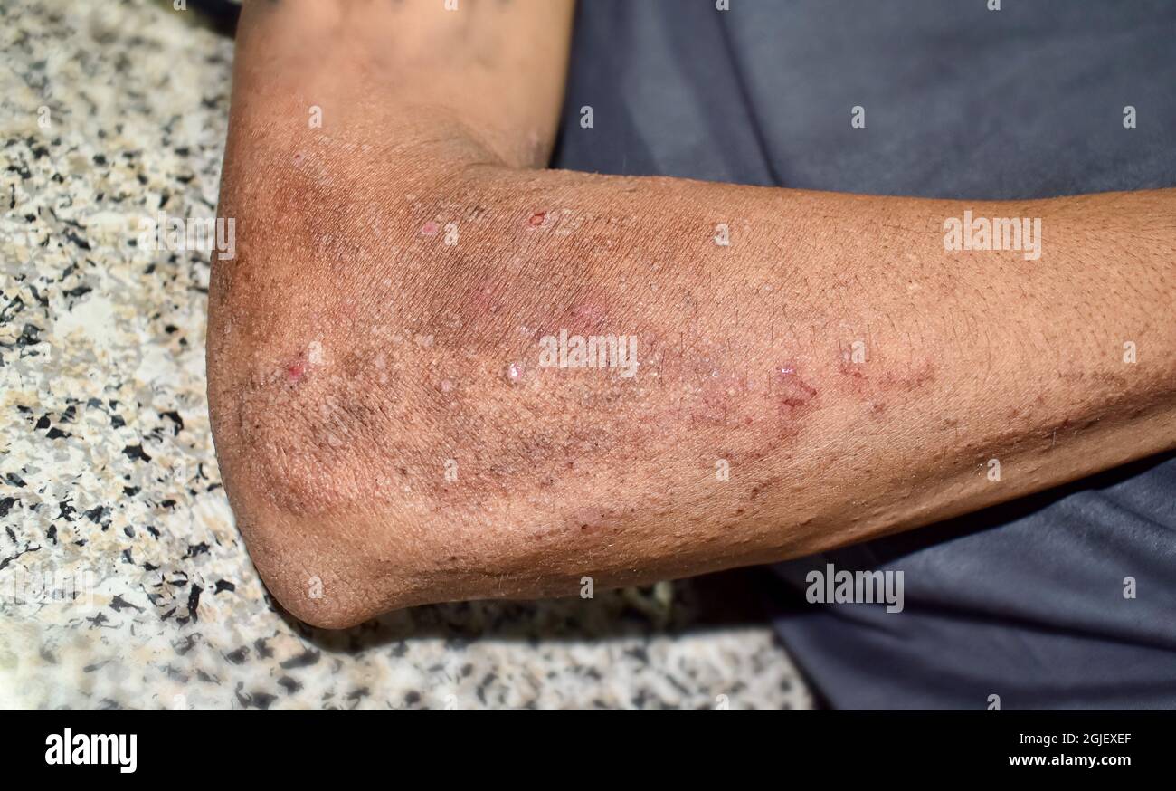 Alcoholic dermatitis due to niacin or vitamin B3 deficiency resulting in pellagra. Rough and dry skin of forearm. Stock Photo